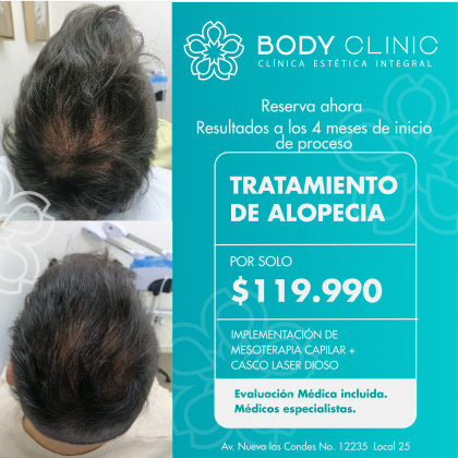 Tratamiento de Alopecia