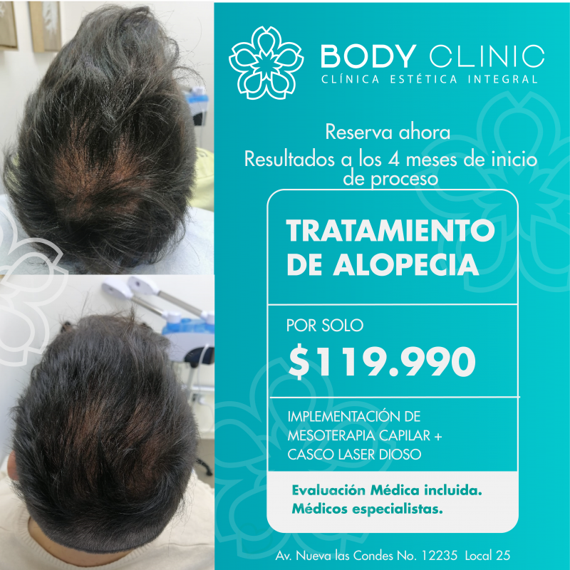 Tratamiento de Alopecia